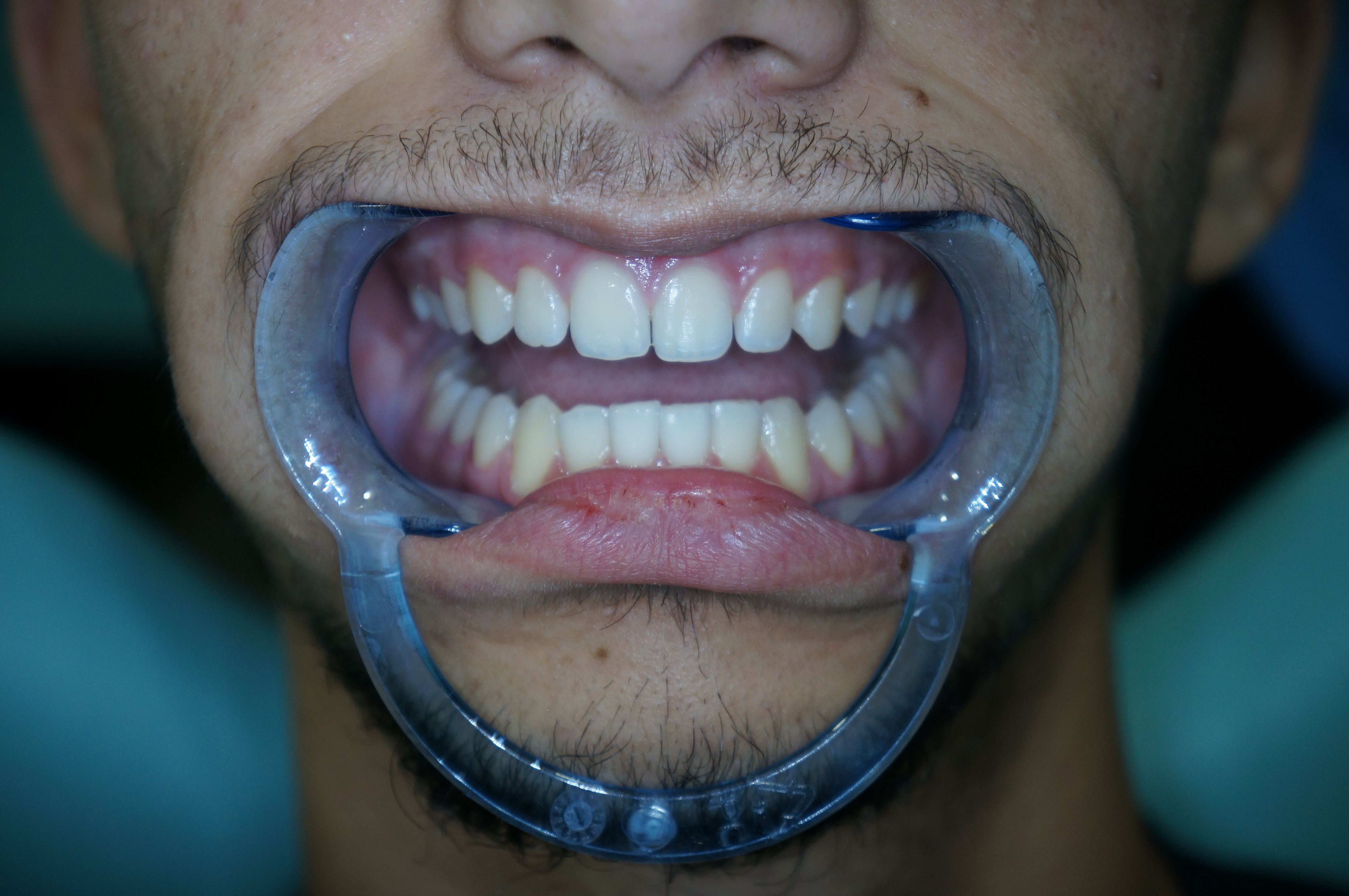 Risultato finale dopo il trattamento ortodontico con denti perfettamente allineati