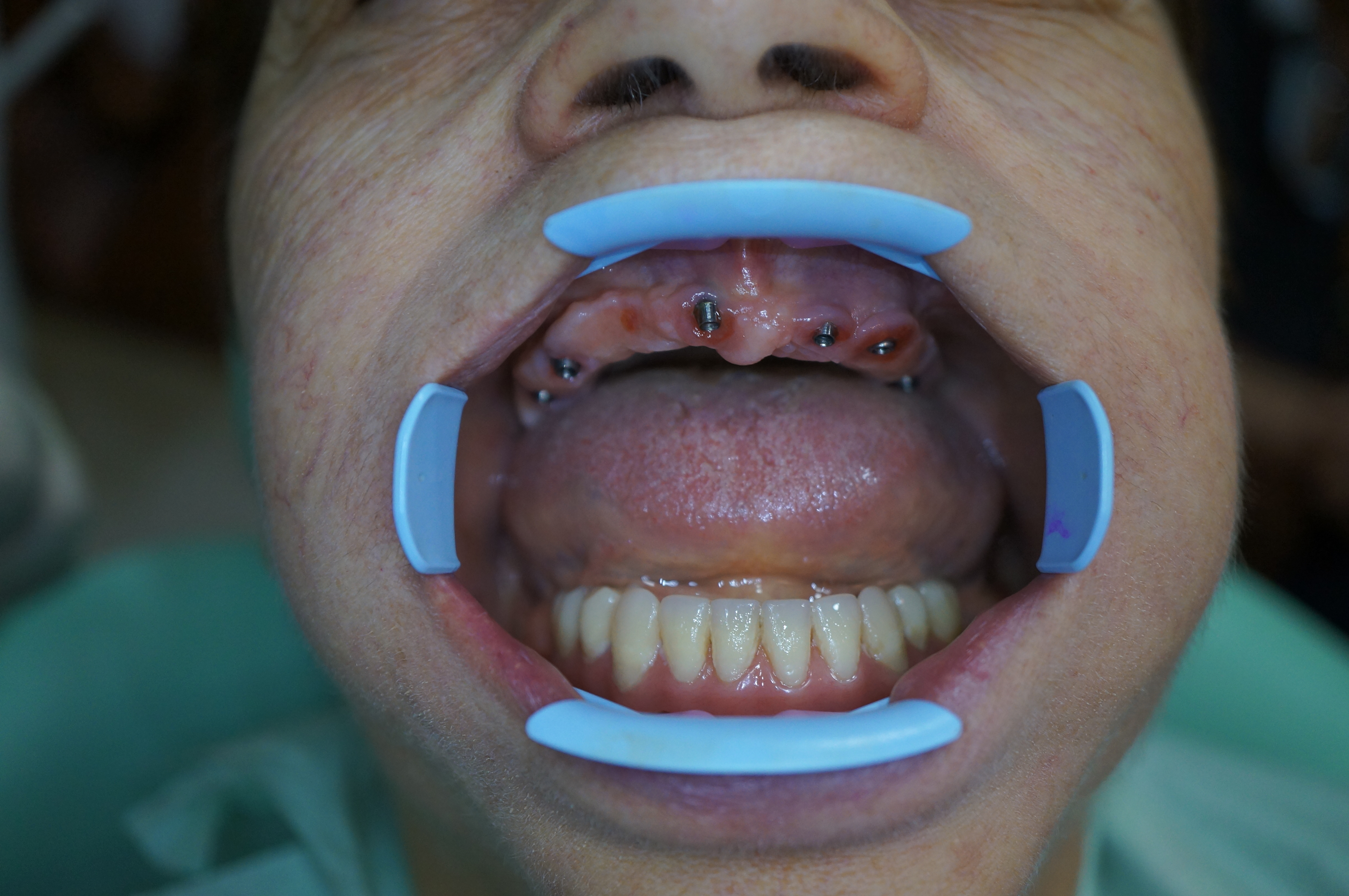 Situazione clinica prima dell'intervento implantare