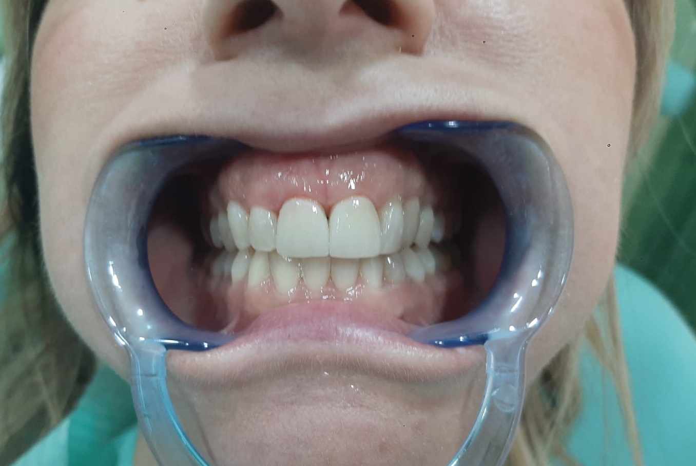 Caso 3: risultato finale dopo l'applicazione delle corone estetiche in ceramica