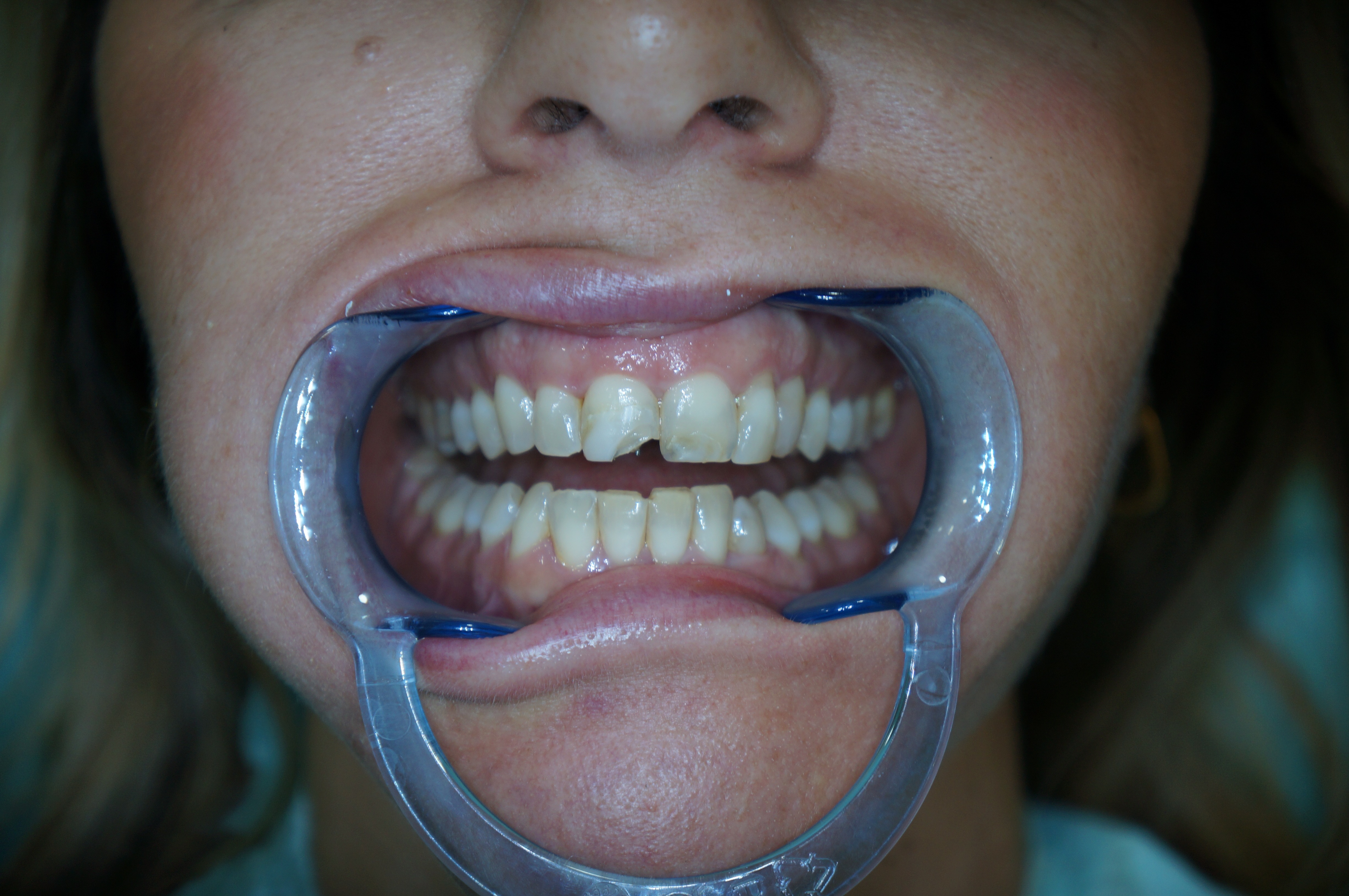 Caso 3: situazione clinica prima del trattamento con corone in ceramica